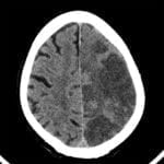 Left MCA Stroke on axial CT head