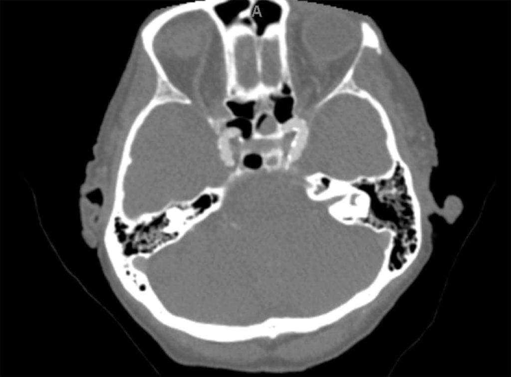 Basilar Occlusion