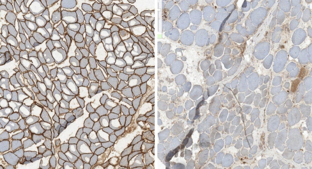 Muscle pathology Dystrophin staining of normal muscle compared to a muscle of patient with DMD