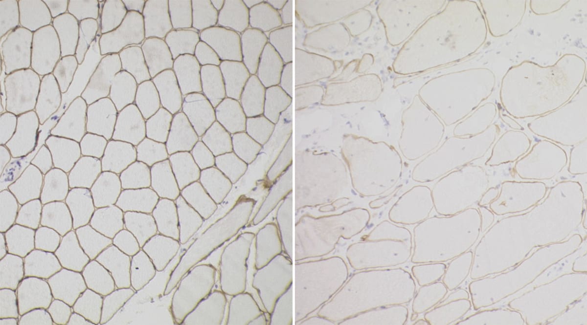 Muscle Pathology Becker Muscular Dystrophy