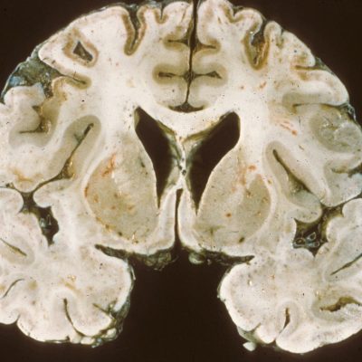Global ischemic encephalopathy Bilateral ischemia on gross coronal section of brain