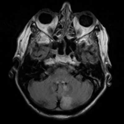 l_pica_stroke_t2flair Left PICA Infarct on brain MRI