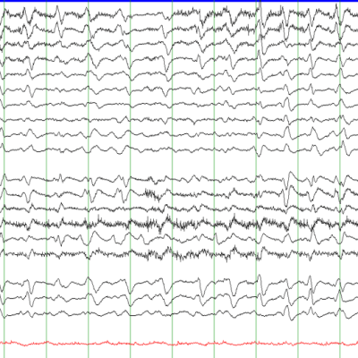 triphasic wave average EEG with GPDs with Triphasic Morphology on Average montage, Secondary to hepatic encephalopathy