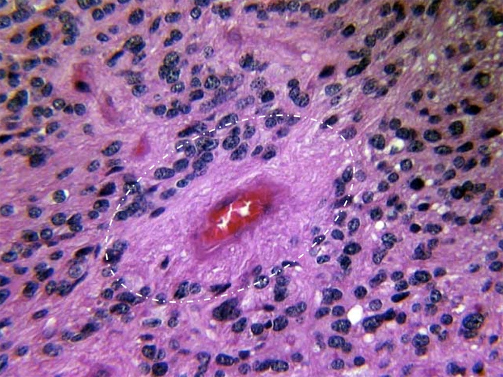 Ependymoma