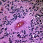 H&E stain of Ependymoma showing fibrillary processes surrounding a vessel, creating a clearing between the tumor nuclei and the vessel, described as a perivascular pseudorosette