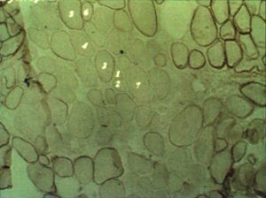 Muscle pathology Mosaic Pattern in Female Duchenne Muscular Dystrophy Carrier