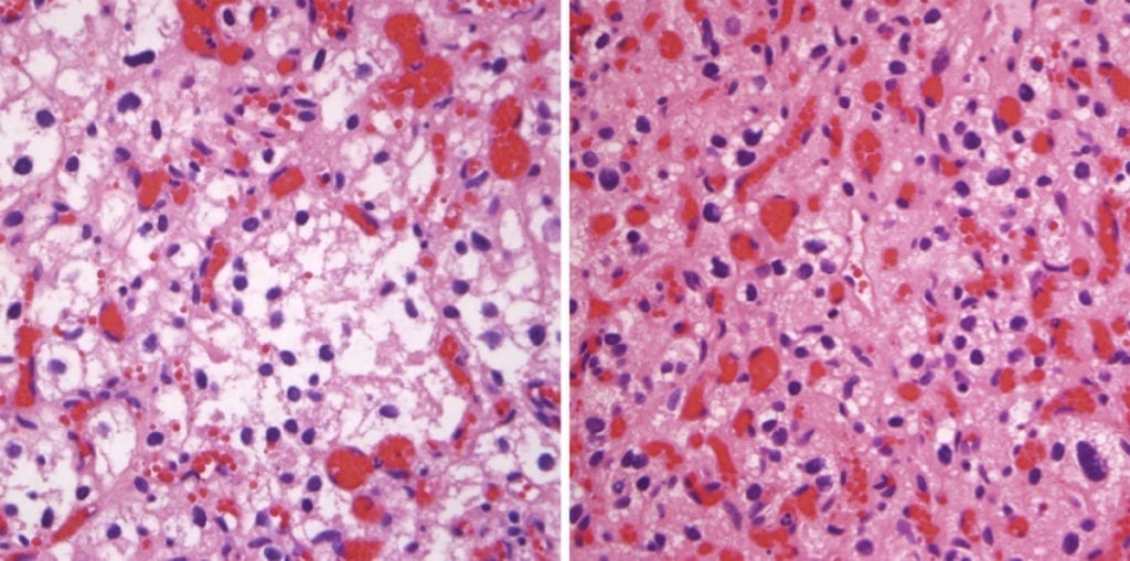 Hemangioblastoma