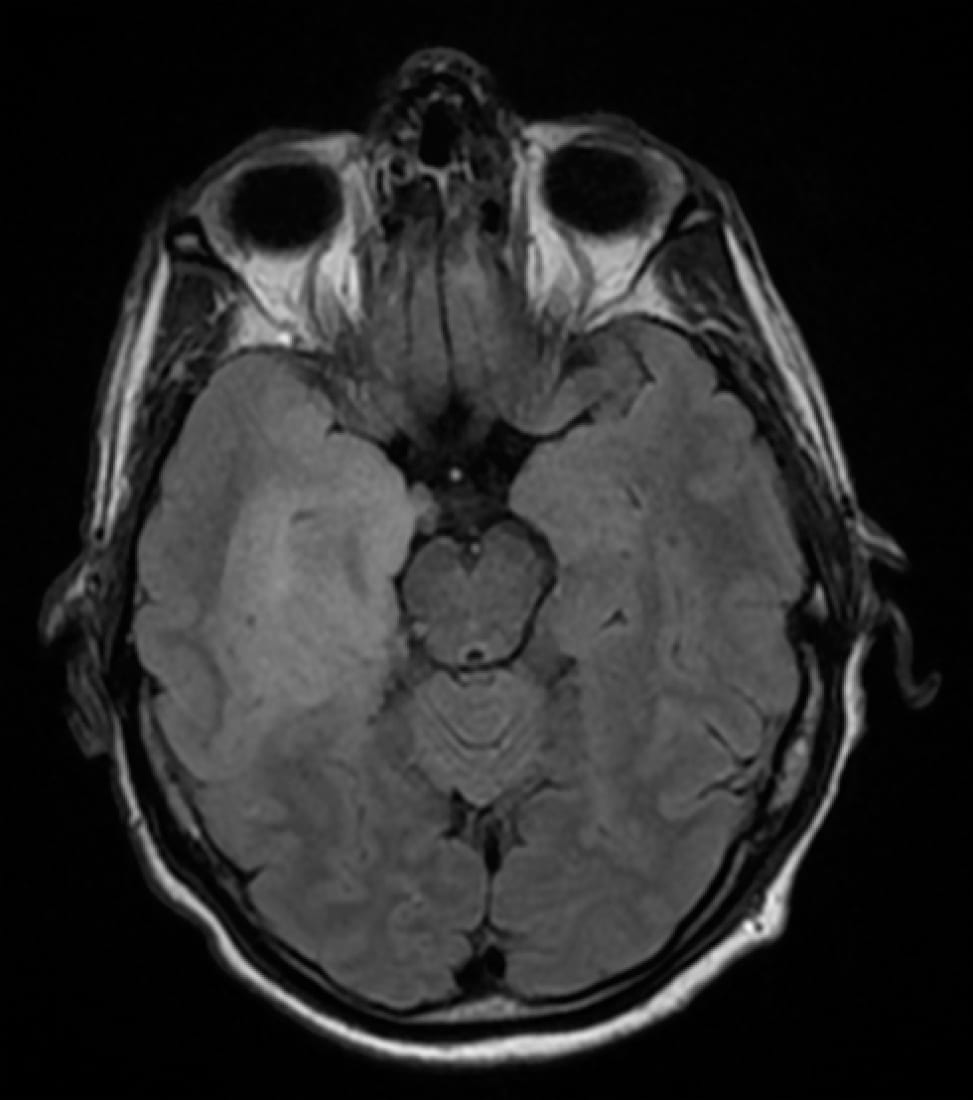 Neuroinfectious disease HSV Encephalitis