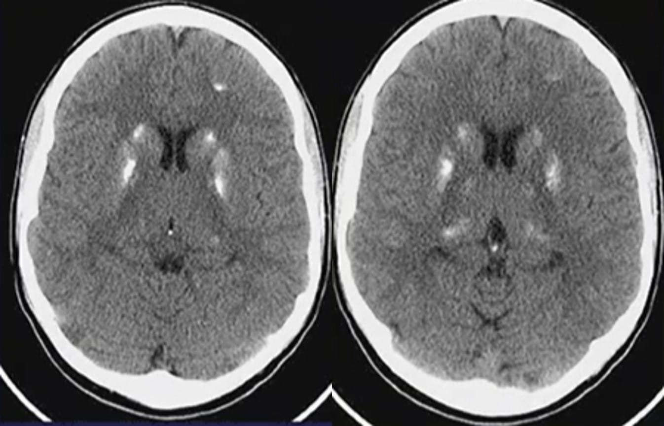 Basal Ganglia & Cerebellum Flashcards | NowYouKnow Neuro