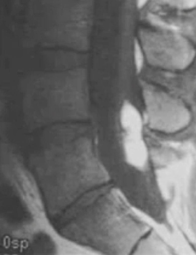 Intraspinal Lipoma