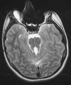 Joubert Syndrome