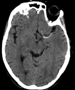 Left Hyperdense MCA Sign