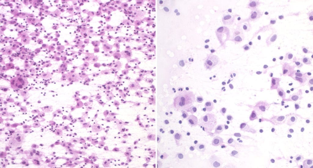 Langerhans Cell Histiocytosis