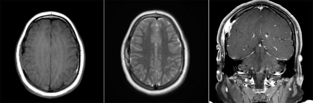 Langerhans Histiocytosis