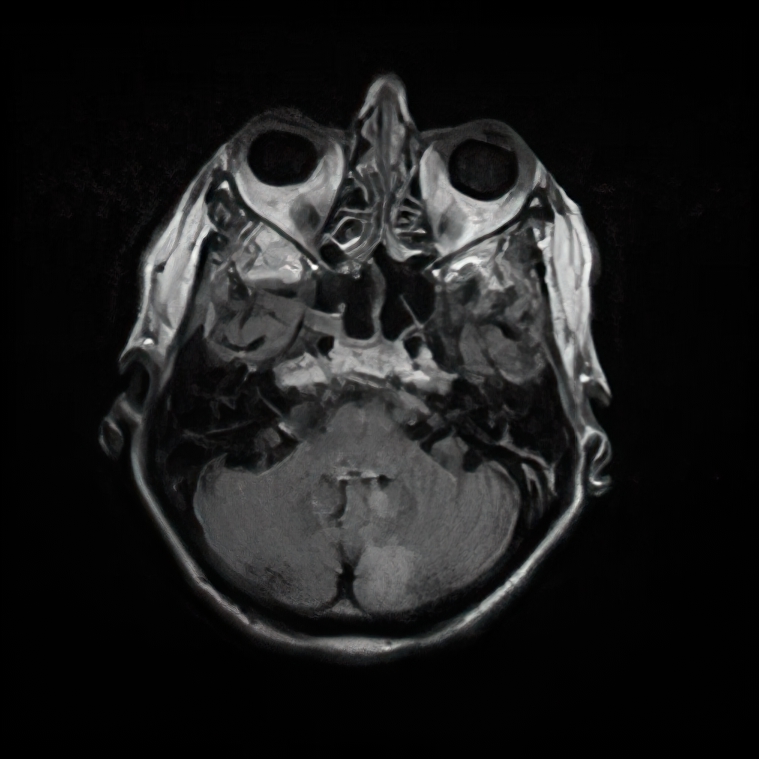 FLAIR axial MRI brain with hyperintensity within the left cerebellum in the distribution of the posterior inferior cerebellar artery due to stroke