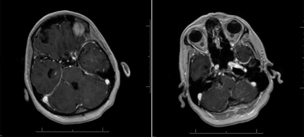 Leptomeningeal Carcinomatosis