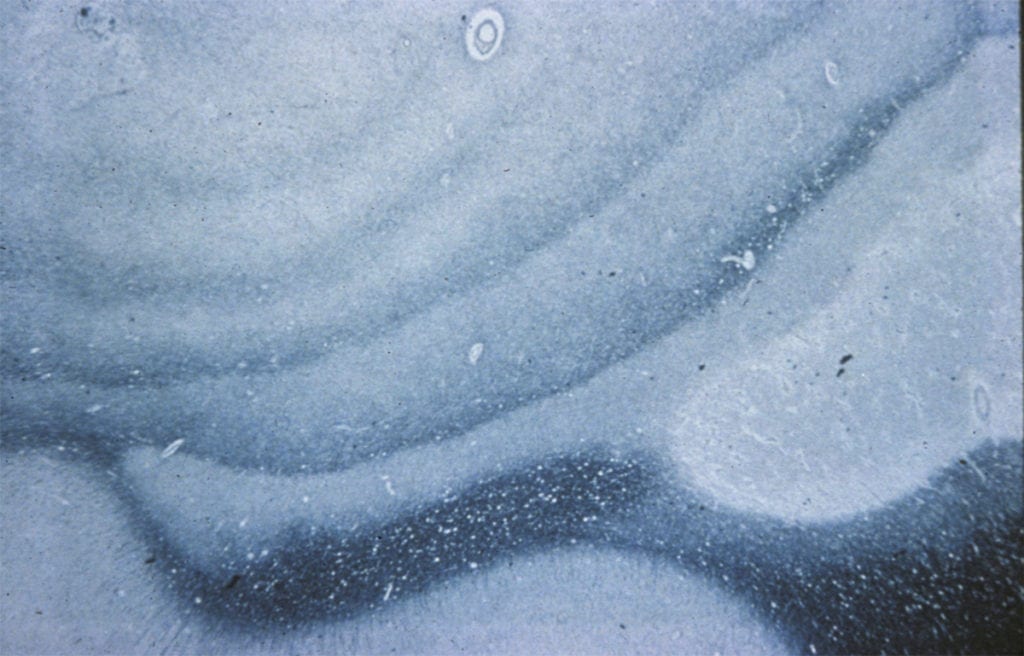 Balos Concentric Sclerosis MS Variant