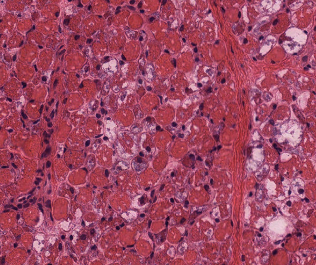 Pompe Disease lysosomal glycogen accumulation