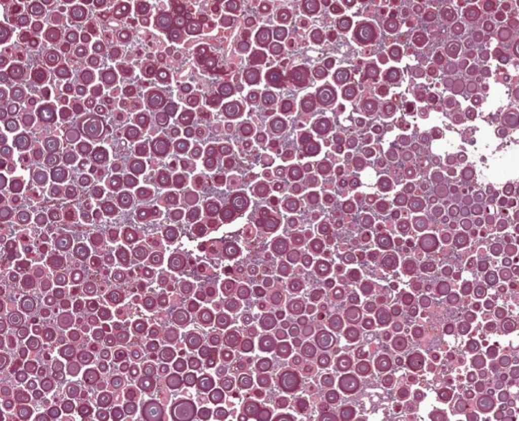 Meningioma Biopsy Psammoma Bodies