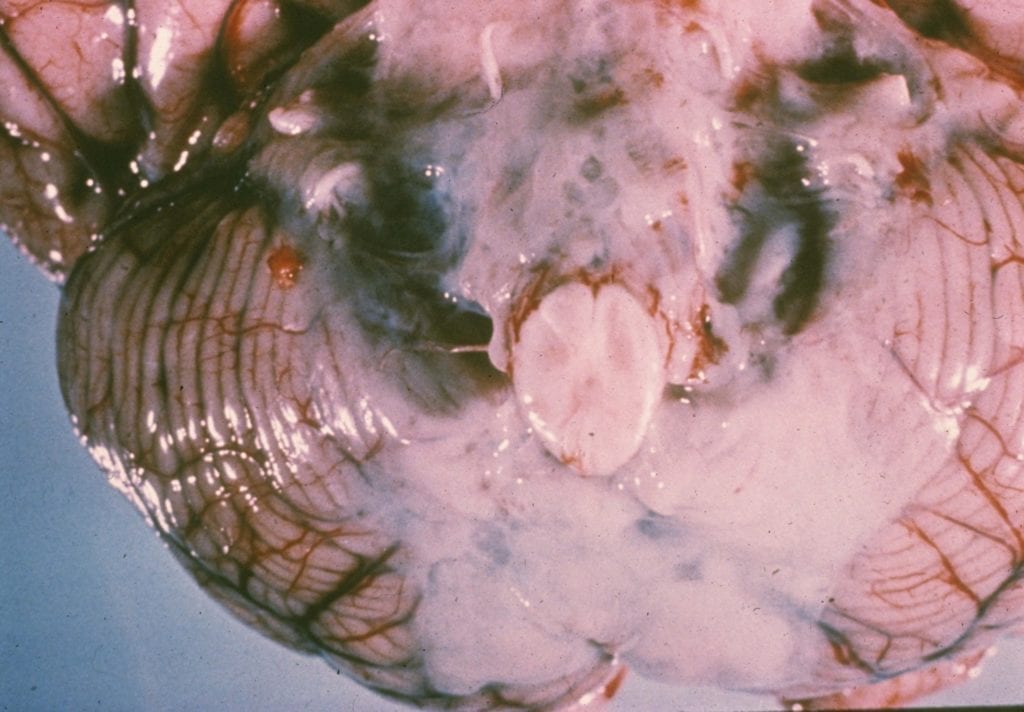 Abundant gray-white exudate surrounding the brainstem and cerebellum secondary to pneumococcal meningitis