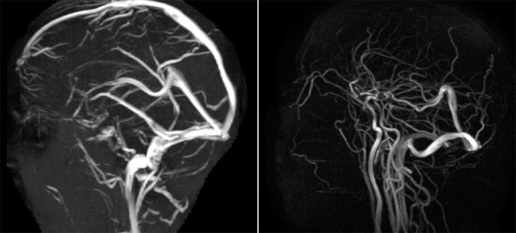 Superior Sagittal Sinus Thrombosis
