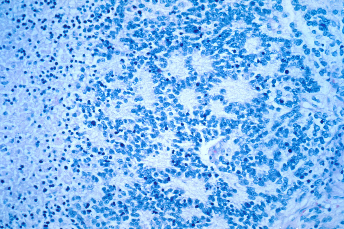 Neuroblastoma with rosettes on micro pathology slide