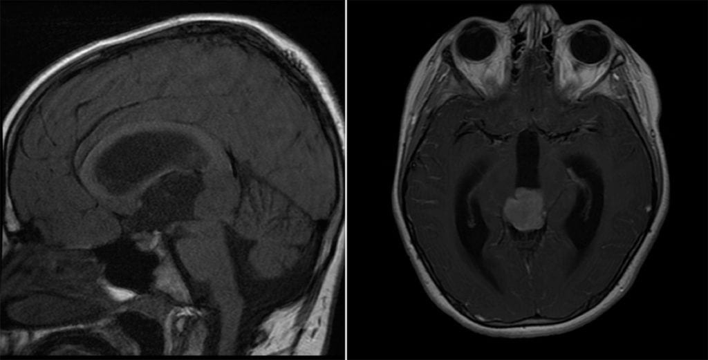 Pineoblastoma