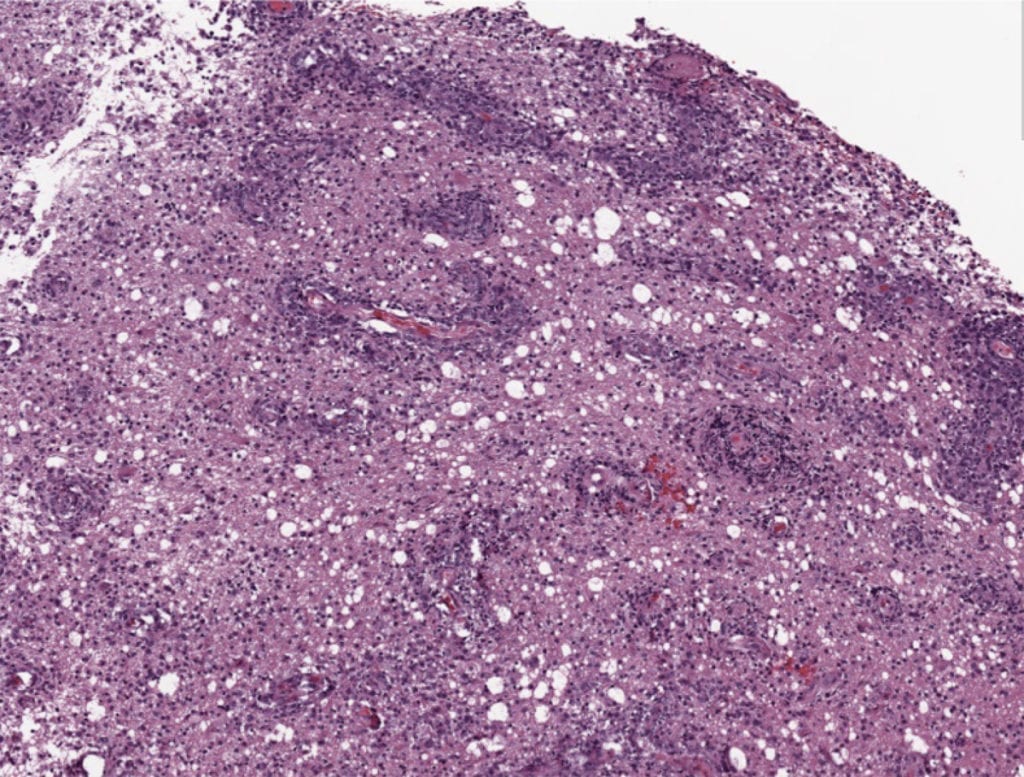 Primary CNS Lymphoma