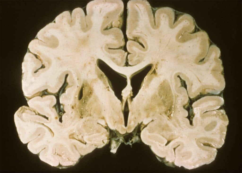 Vascular Neurology | Review and Quiz | NowYouKnow Neuro