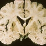 Lacunar Stroke in Right Putamen on coronal gross brain pathology specimen