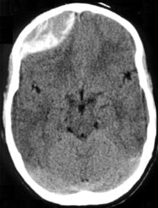 Right Epidural Hematoma