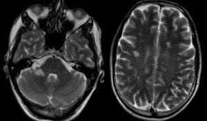 Acute Disseminated Encephalomyelitis (ADEM)