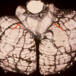 tonsillar_herniation_cerebellum-1.jpg