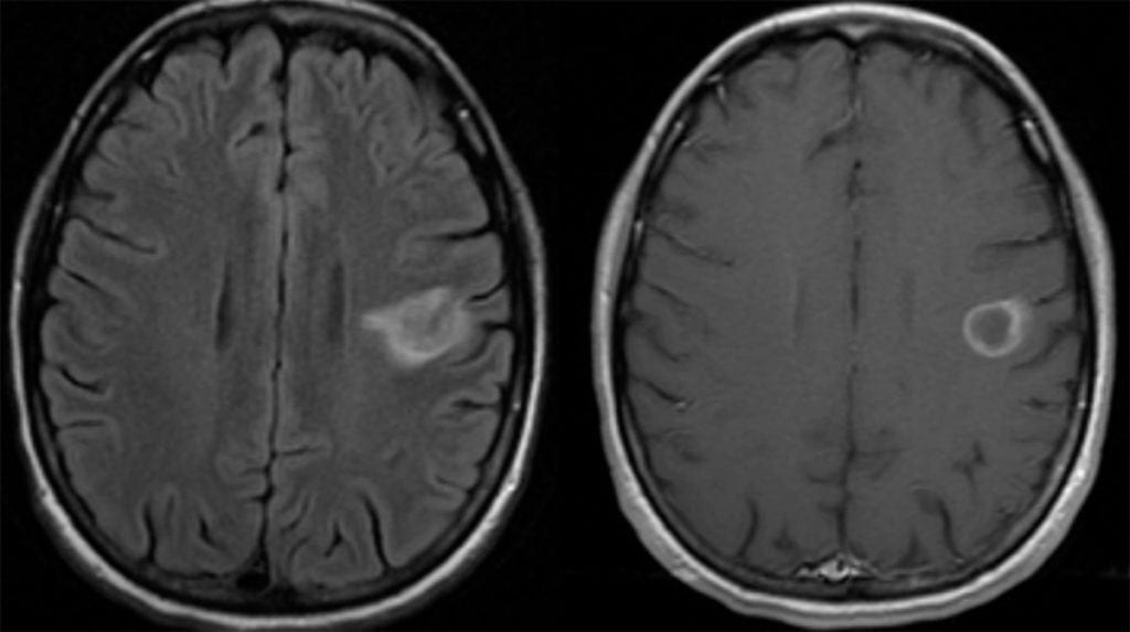 Neuroinfectious Disease Toxoplasmosis MRI ring enhancing