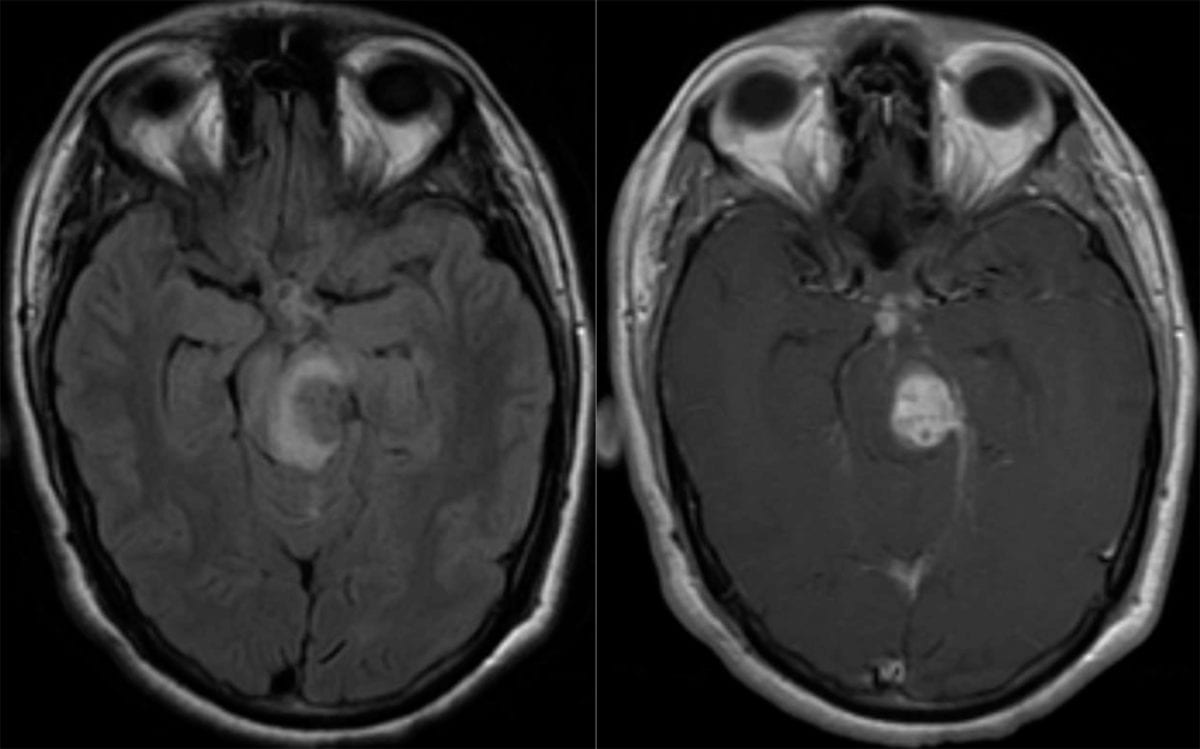 Neuroinfectious disease Tuberculoma