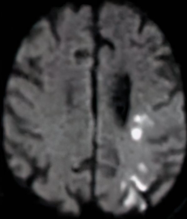Hypoxic Ischemic Encephalopathy Hypoxic Ischemic Encephalopathy on Axial MRI, DWI sequence